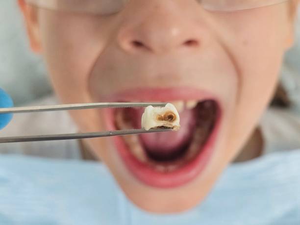 Best Emergency Tooth Extraction in Four Bridges, OH